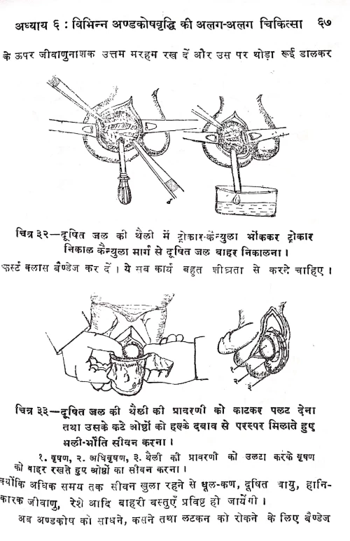 Hydrocele Aur Hernia Operation